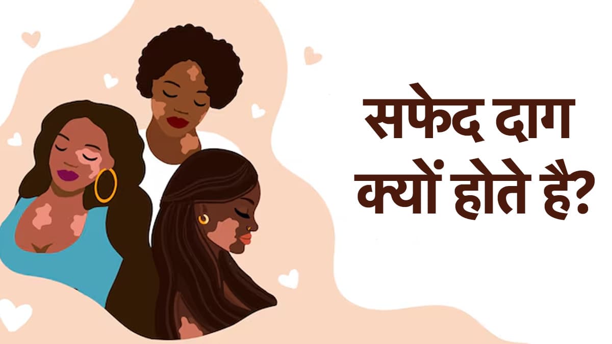 World Vitiligo Day 2025: क्या छूने से होती है ये बीमारी? जानें सफेद दाग की डिजीज का काला सच