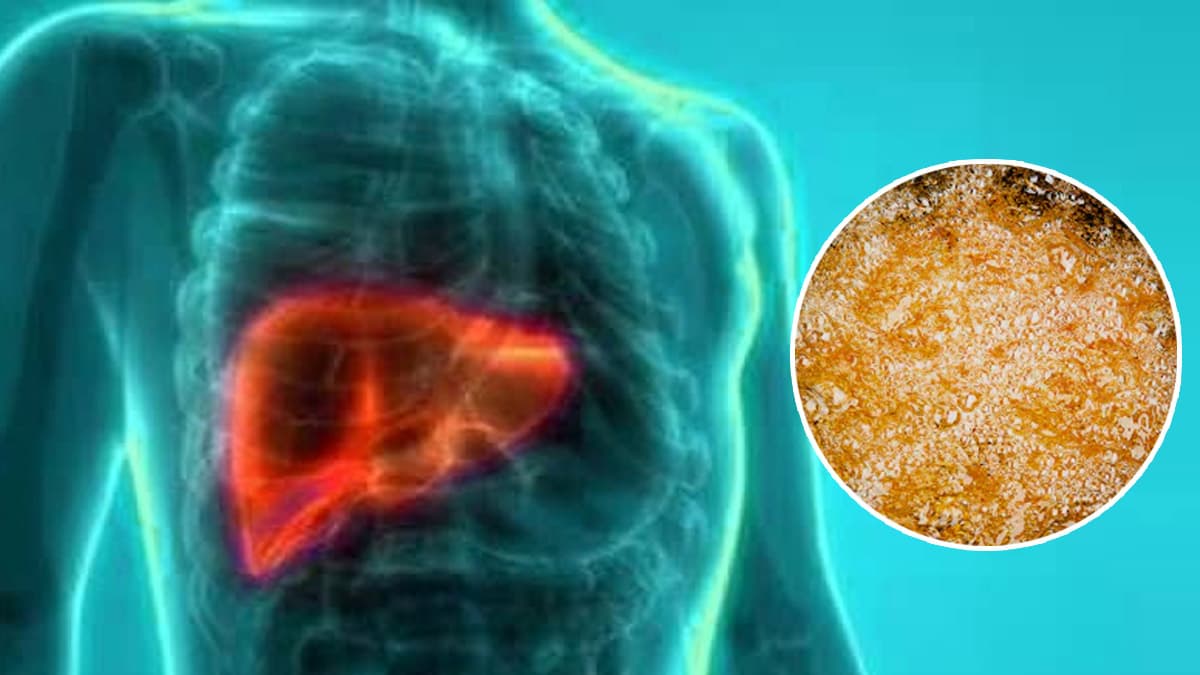 Fatty Liver Causes: फैटी लिवर होने पर ये चीजें बिल्कुल न खाएं, डॉक्टर ने दिए टिप्स