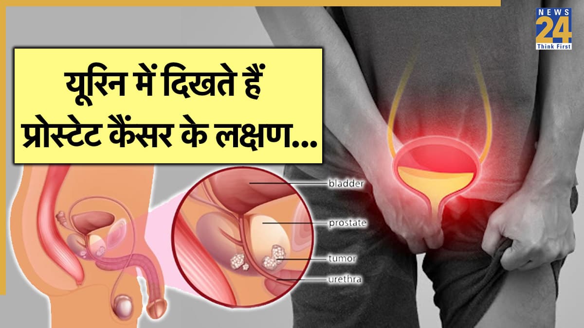 पेशाब में इन 5 लक्षणों का दिखना है प्रोस्टेट कैंसर का संकेत, डॉक्टर से जानें उपाय
