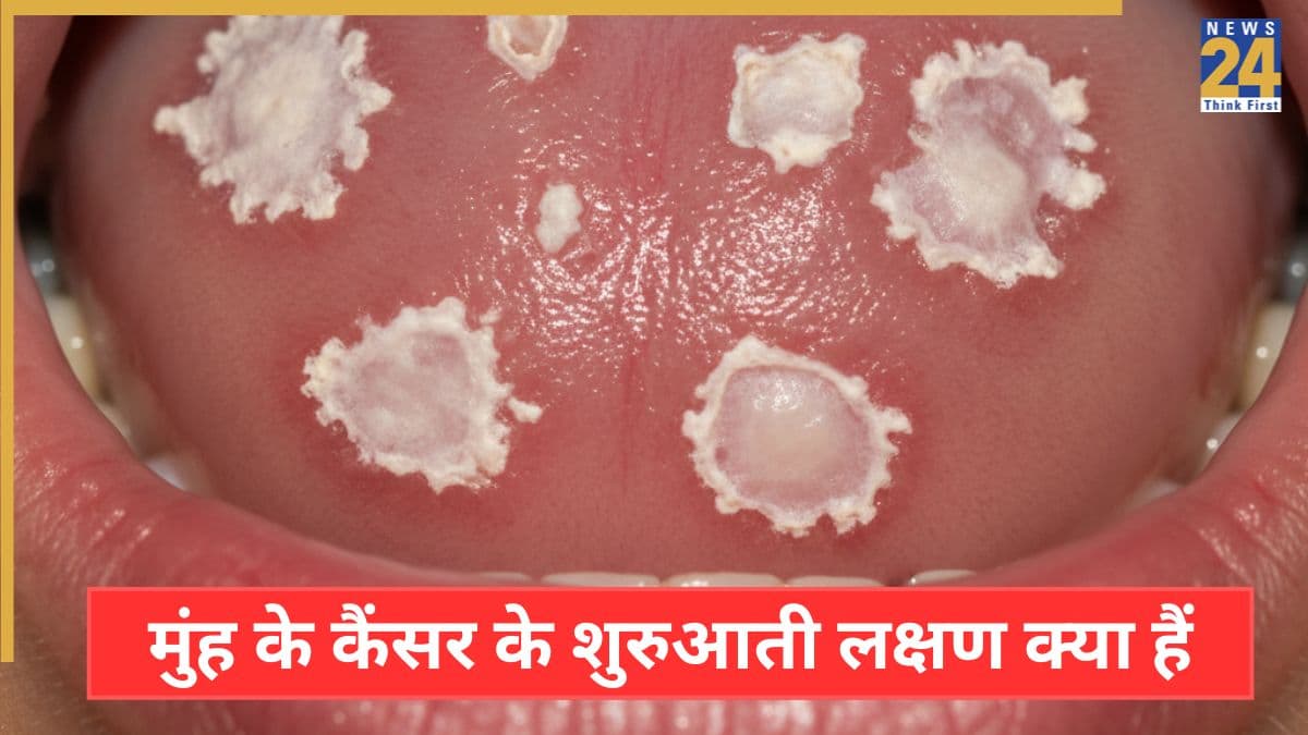 मुंह के कैंसर के शुरुआती लक्षण क्या होते हैं? यहां जानिए स्टेज 1 माउथ कैंसर क्या है