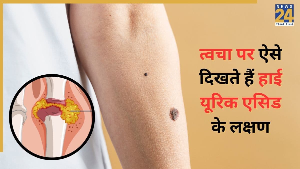 जोड़ों ही नहीं बल्कि त्वचा पर भी नजर आते हैं हाई यूरिक एसिड के लक्षण, वक्त रहते पहचानें ये निशान