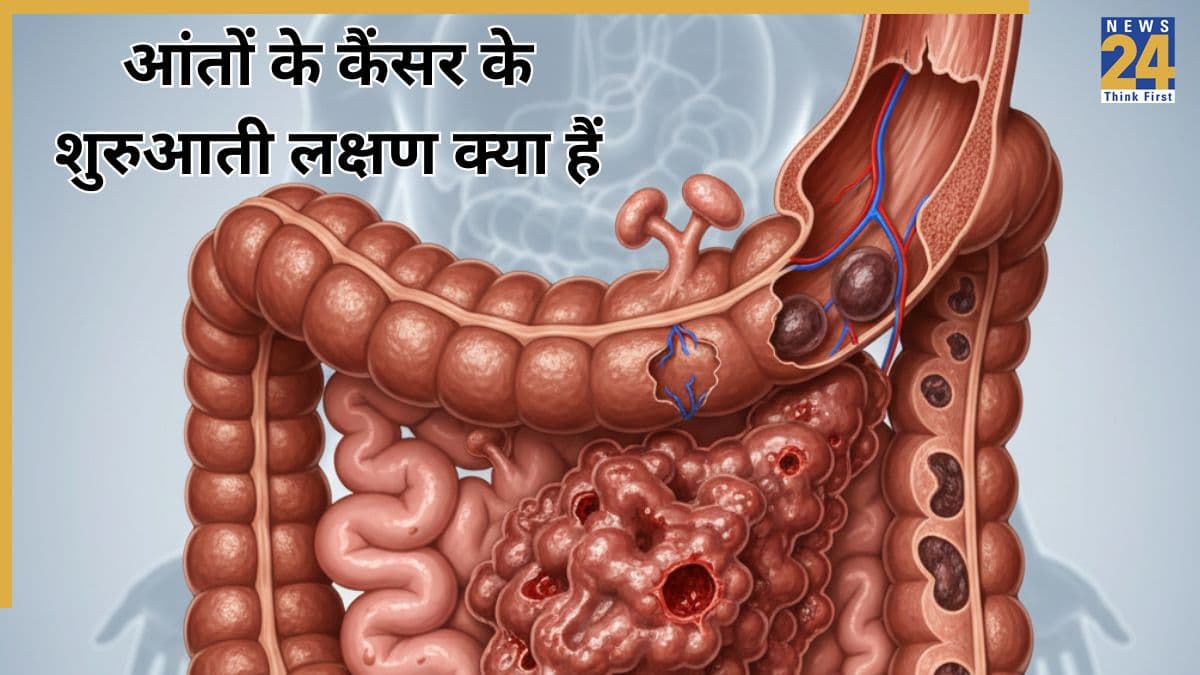 युवाओं में बढ़ रहा है आंतों के कैंसर का खतरा, यहां जानिए कोलन कैंसर का पहला संकेत क्या है