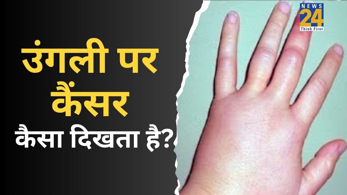 Finger Cancer: उंगलियों पर कैंसर के क्या लक्षण हैं? दर्द, गांठ या खिलजी होने पर जानिए डॉक्टर के पास कब जाना चाहिए