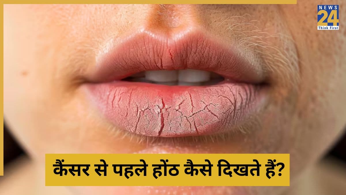 Lip Cancer: बार-बार होंठों पर पपड़ी जमने का कारण कैंसर तो नहीं? शुरुआती 3 लक्षणों की तुरंत करें पहचान