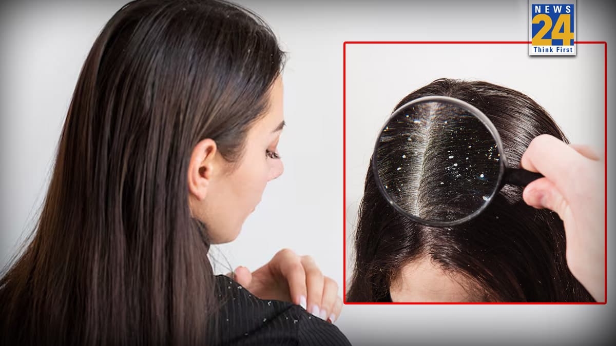 सिर की रूसी से परेशान हैं? Dandruff हटाने के लिए अपनाएं ये देसी तरीका और देखें कमाल