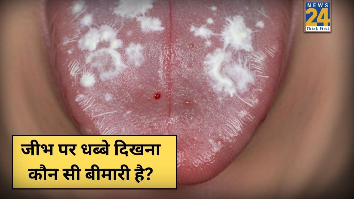 क्या मुंह में सफेद धब्बे का मतलब कैंसर है? यहां जानिए जीभ पर सफेद परत क्यों बनती है