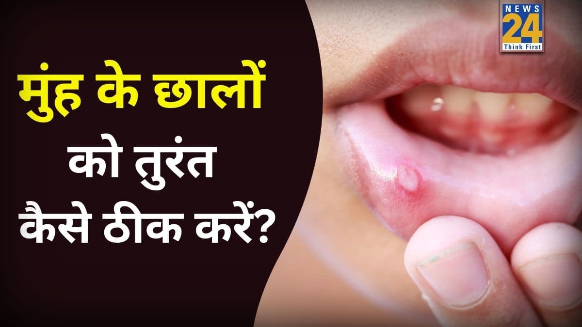 छाले किस विटामिन की कमी से होते हैं? एक्सपर्ट ने बताया नेचुरल तरीके से कैसे दर्द में मिलेगा मुंह को आराम