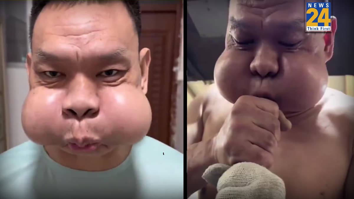Viral Video: मेंढक की तरह हो गया शख्स का चेहरा, चौंका देगा चीन का ये वायरल वीडियो