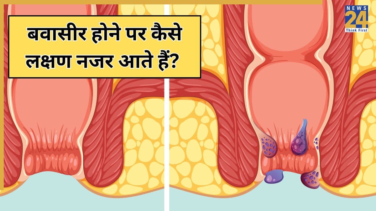 अंदरूनी बवासीर के क्या लक्षण हैं और बवासीर का मुख्य कारण क्या है, यहां जानिए Piles Symptoms, कारण और उपचार