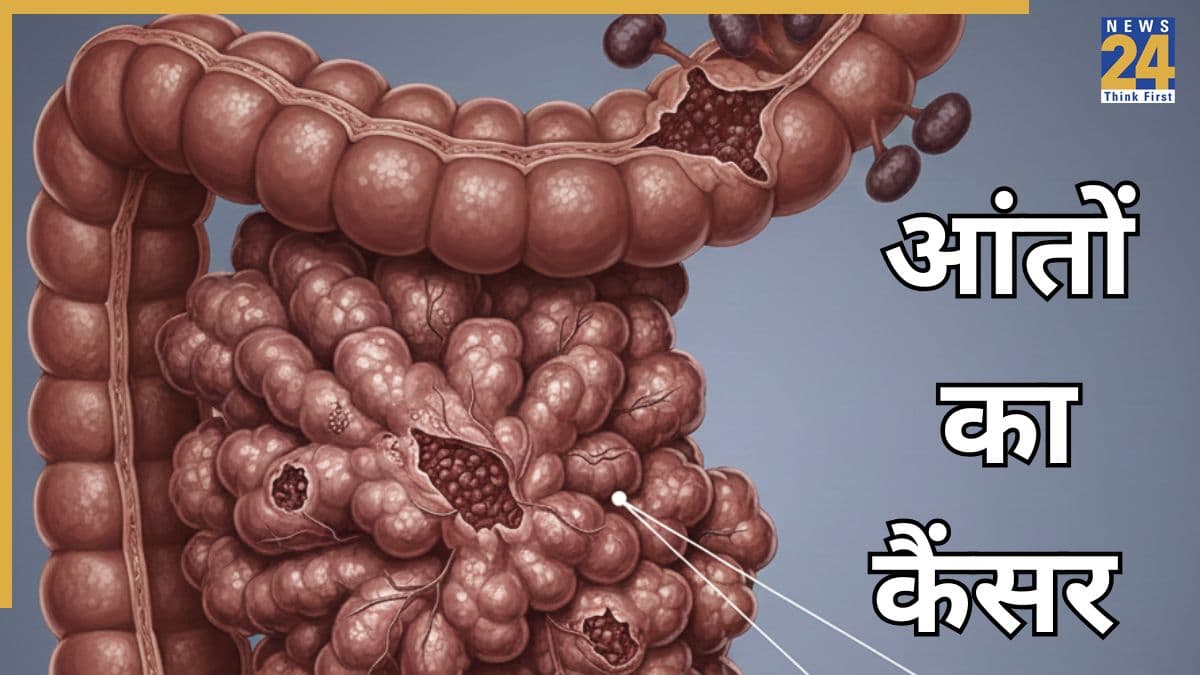 आंत के कैंसर के क्या लक्षण हैं? मल में दिखे यह चीज तो तुरंत कराएं टेस्ट