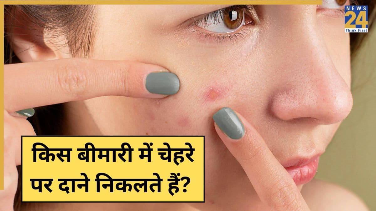 किस बीमारी में चेहरे पर निकलते हैं दाने? बार-बार फुंसियां निकलें तो ना करें इग्नोर