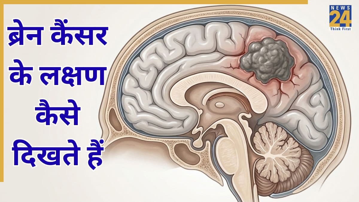 ब्रेन कैंसर के शुरुआती लक्षण क्या हैं? यहां जानिए Brain Cancer Symptoms कैसे दिखते हैं