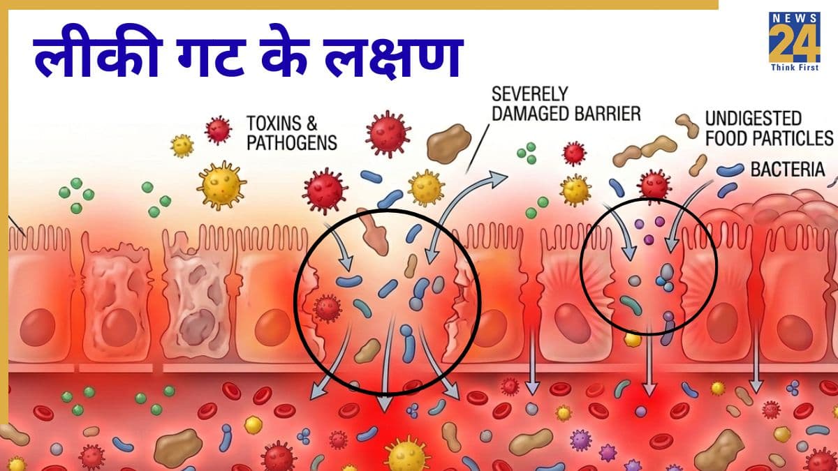 लीकी गट सिंड्रोम के क्या लक्षण हैं? जानिए कैसे पता चलेगा आंतों में हो गया है छेद