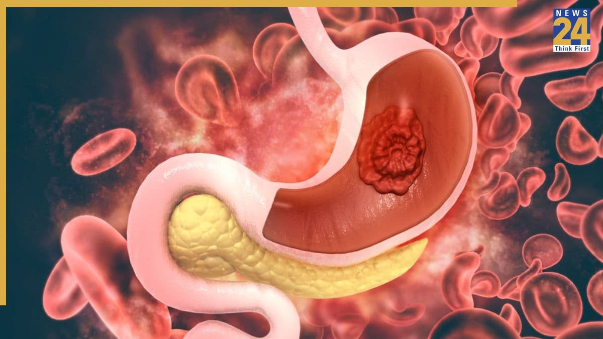 पेट में बनने वाली गैस को ना समझें मामूली, हो सकती है गंभीर बीमारी… इन संकेतों को बिल्कुल ना करें अनदेखा