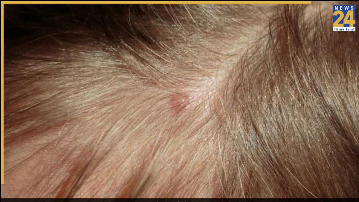 Forehead Pimples