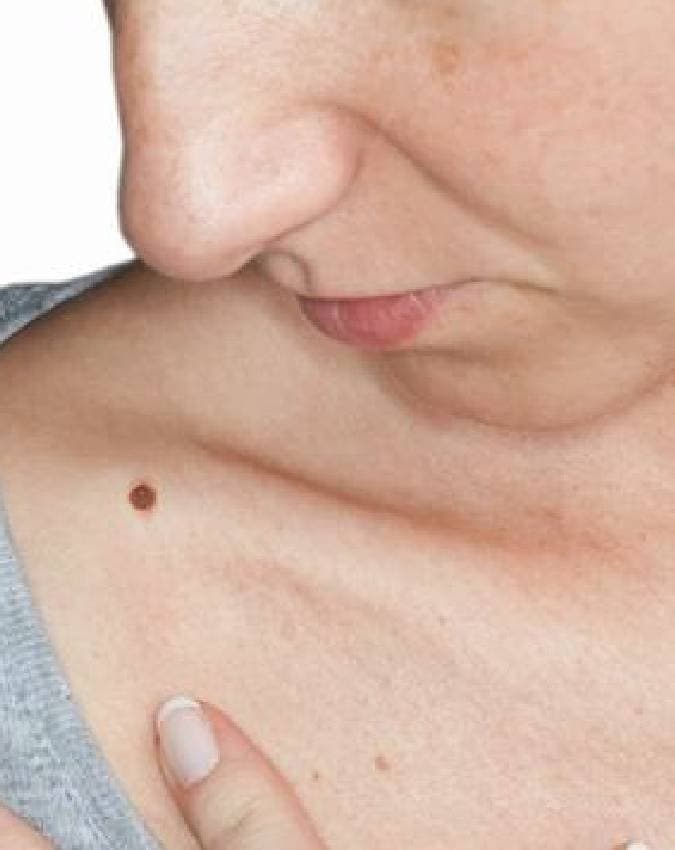 दाएं कंधे का तिल: सफलता का संकेत