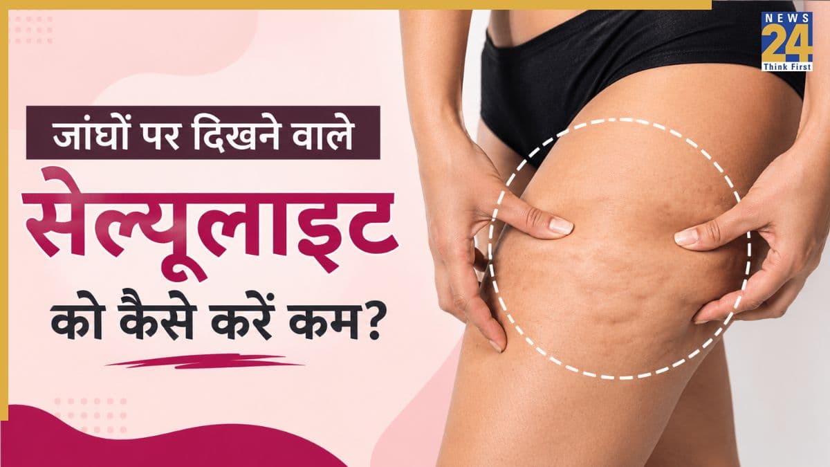 महिलाओं की जांघों पर क्यों नजर आता है सेल्यूलाइट? डॉक्टर ने बताया इसे ठीक करने के लिए क्या करना चाहिए