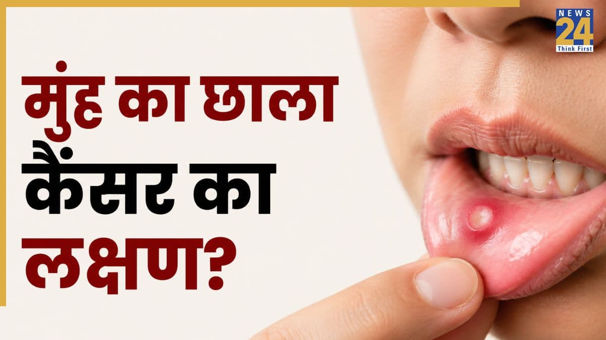 Oral Cancer Signs: मुंह का छाला कब बन सकता है कैंसर? ओनकोलॉजिस्ट डॉ. पुनीत गुप्ता ने बताए मुंह के कैंसर के लक्षण