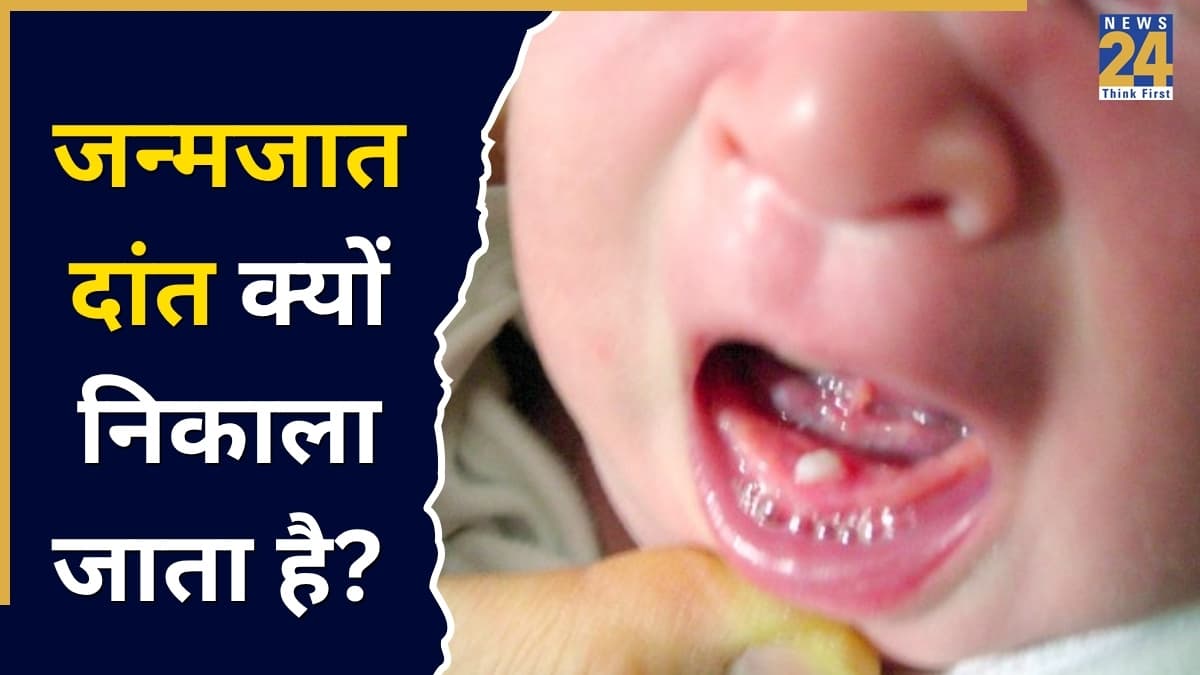 ठाणे में 1 महीने के बच्चे का निकाला गया दांत! जानिए Natal Teeth को हटाना कब है जरूरी