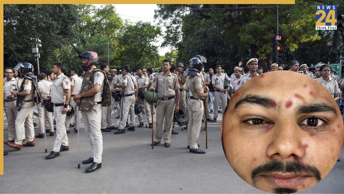 जंतर-मंतर पर पैलेट गन से जबलपुर का इरशाद जख्मी, छर्रे लगने के बाद आंख की हुई सर्जरी