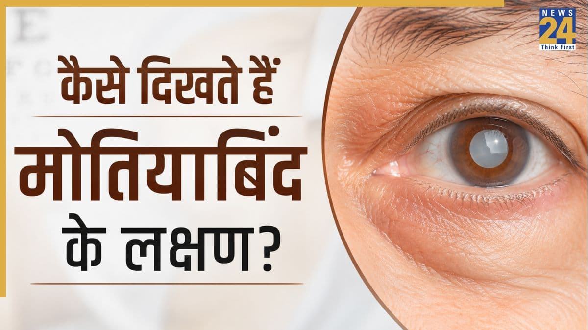 मोतियाबिंद का पहला संकेत क्या है? यहां जानिए इस बीमारी के शुरुआती लक्षण कैसे दिखते हैं