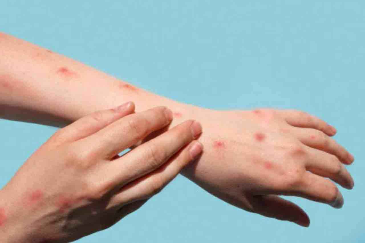 Monkeypox