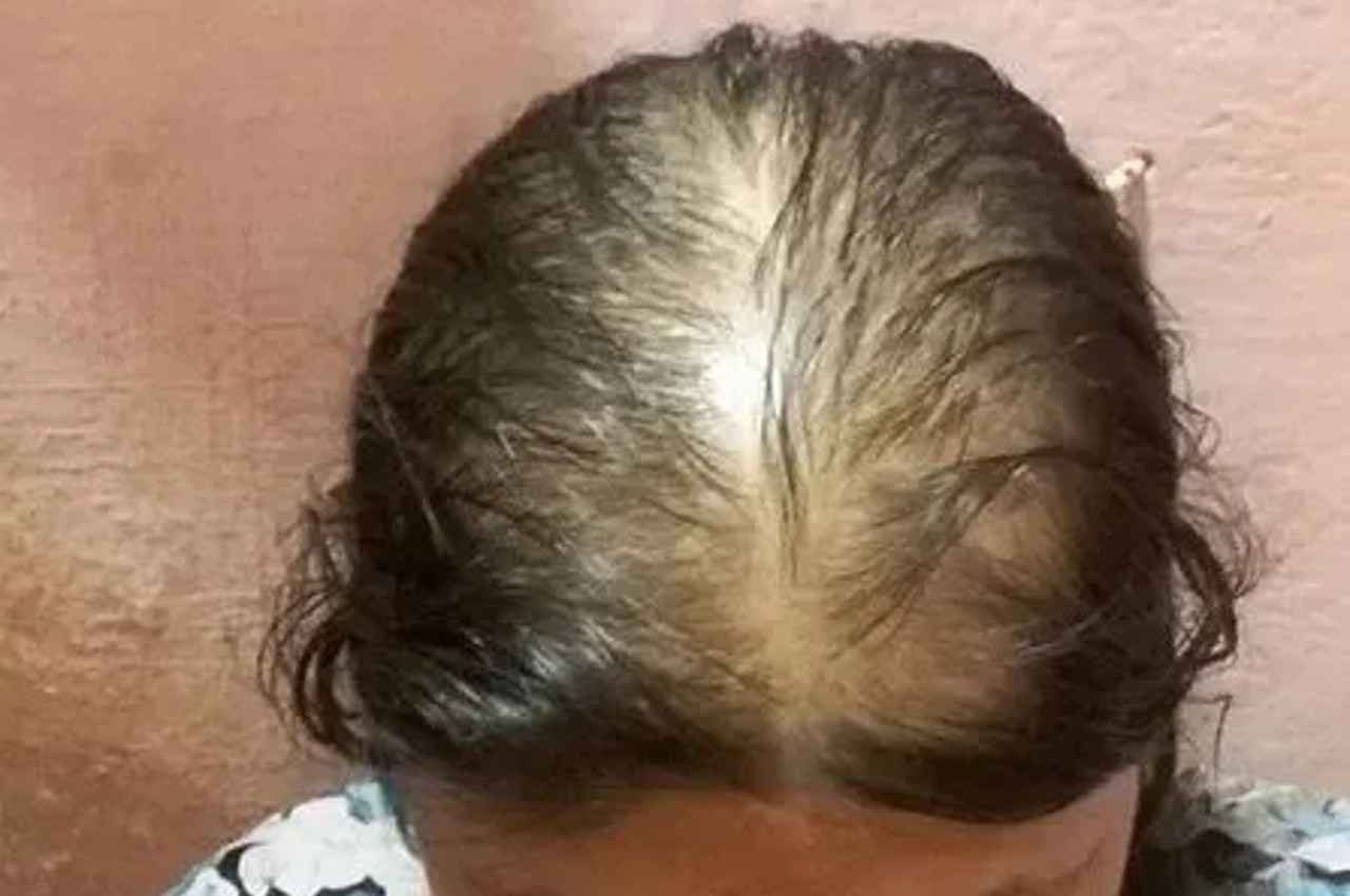 Baldness Treatment: बाल झड़ने से लोग हो जाते हैं गंजेपन का शिकार, बचने के लिए करें ये 3 काम