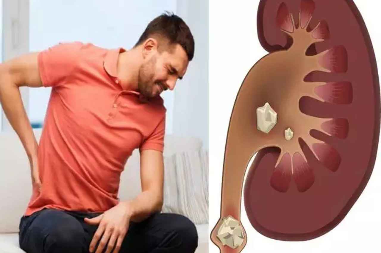 Kidney Stone diet: पथरी की समस्या में भूलकर भी न खाएं ये चीजें, वरना पड़ जाएंगे लेने के देने