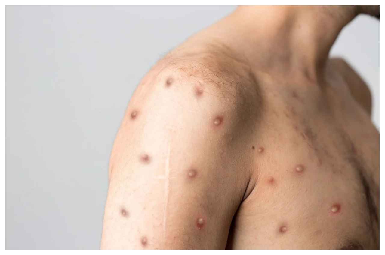 Monkeypox: एक सप्ताह में 20 फीसदी मामले बढ़े, देश में 35 हजार केस