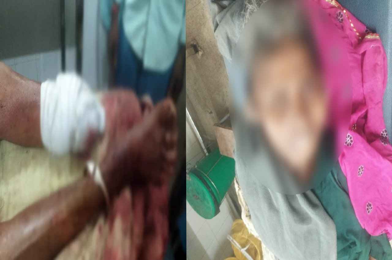 बेखौफ बदमाशों ने आरी से काटा वृद्धा का पैर, चांदी के कड़े लेकर हुए फरार