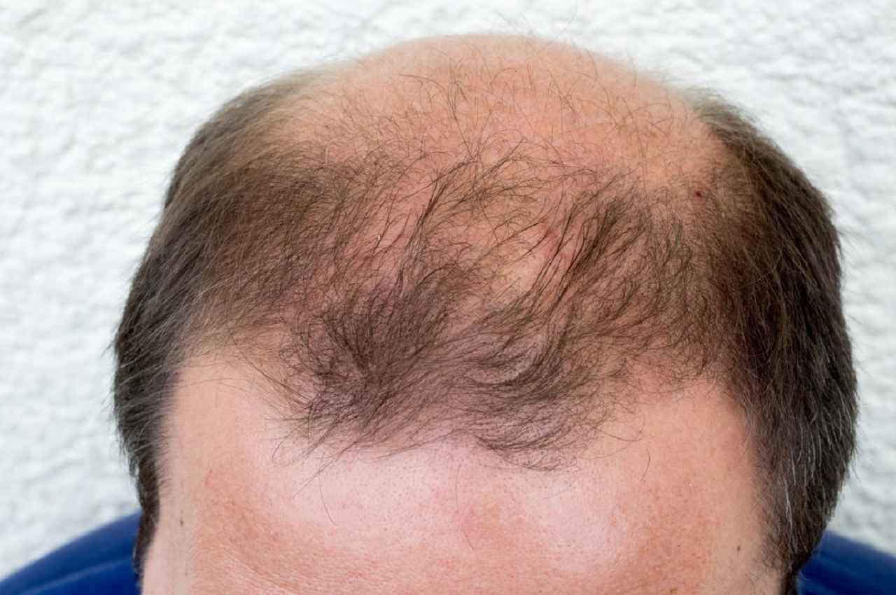 Hair Tips: गंजेपन से हैं परेशान तो बालों ऐसे लगाएं गुड़हल के फूल, फिर देखें कमाल