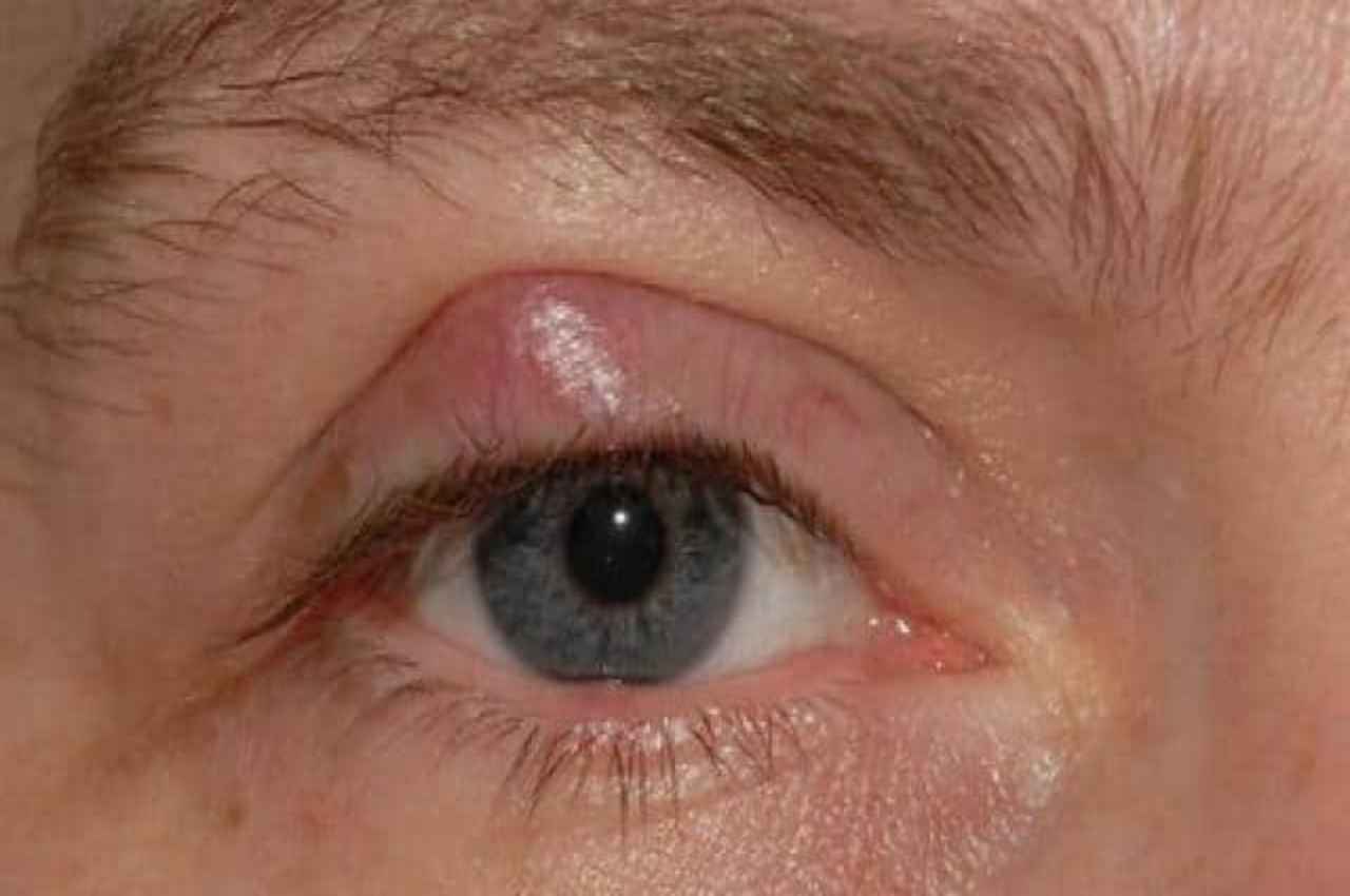 Swelling in Eyelids Causes