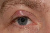 Swelling in Eyelids Causes