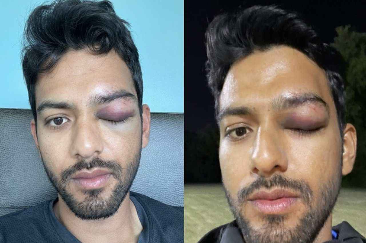 भारत को वर्ल्ड कप दिलाने वाला कप्तान हुआ हादसे का शिकार, बच गई आंख