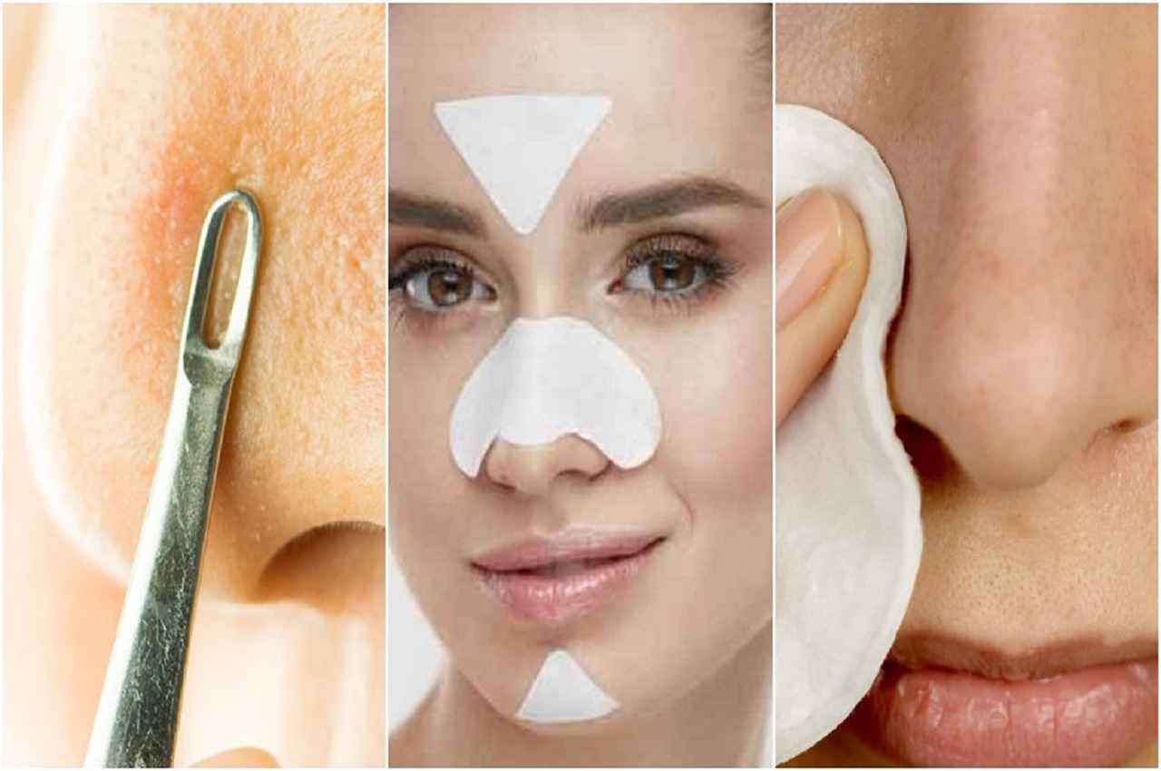 How To Get Rid Of White Heads: चेहरे के व्हाइटहेड्स को आसानी से हटा देती है दही, बस इस विधि को अपनाएं