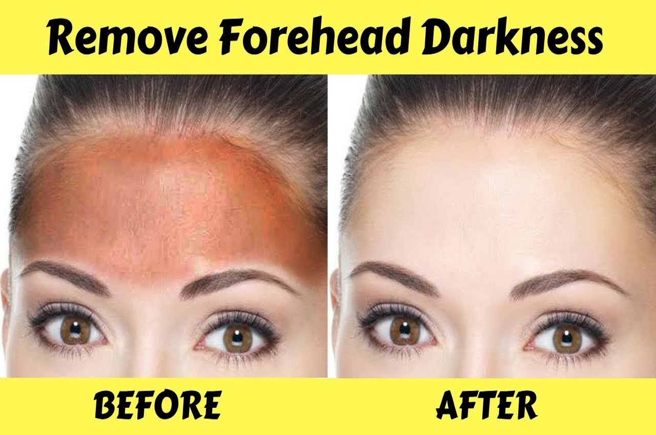 Forehead Darkness