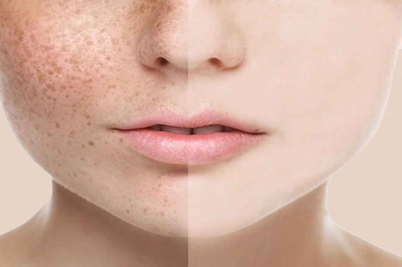 How To Get Rid Of Pigmentation: फेस पिगमेंटेशन को दूर कर देती है किचन में रखी ये एक चीज, बस इस तरह से लगाएं