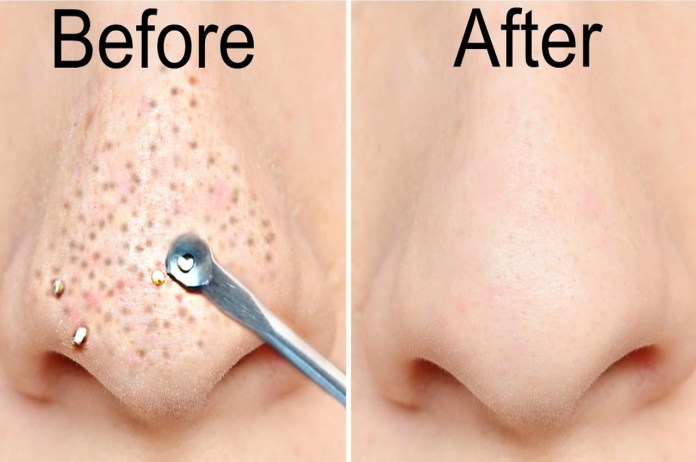 Face Care Tips to remove whiteheads and blackheads