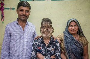 Lalit Patidar disease Werewolf Syndrome