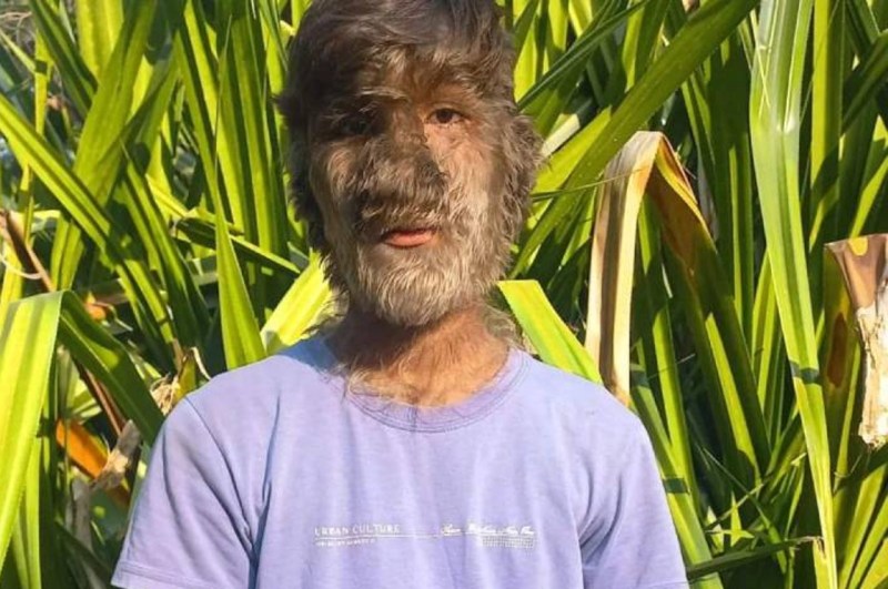 MP ratlam boy Lalit Patidar disease Werewolf Syndrome