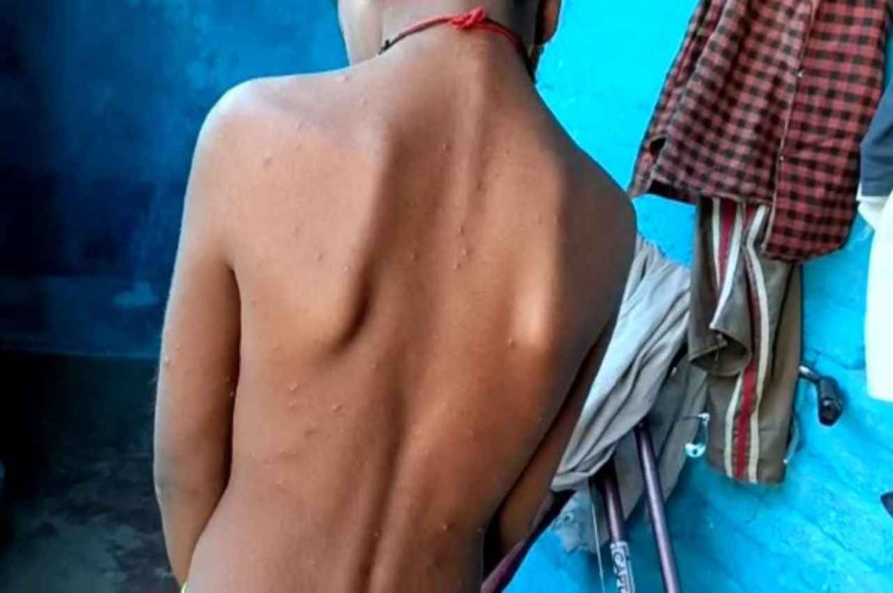 MP के इस जिले में चिकन पॉक्स ने दी दस्तक, 4 दर्जन से अधिक बच्चों के लिए गए सैंपल
