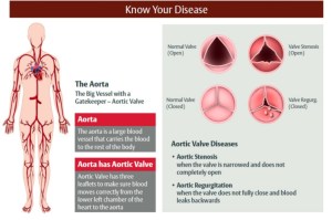 Health News Heart Valve Disease