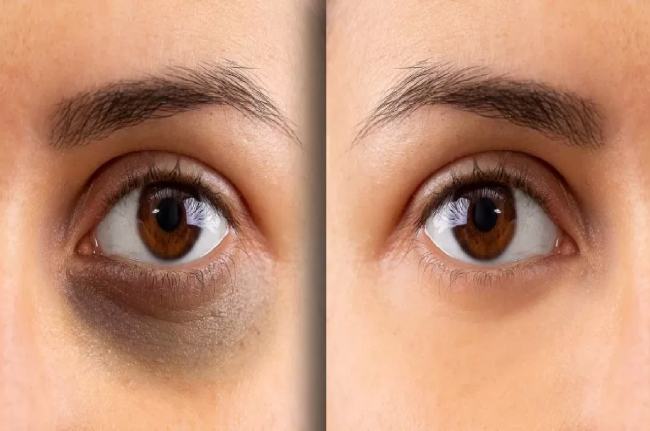 Dark Circle Removal Tips How to remove Dark Circles