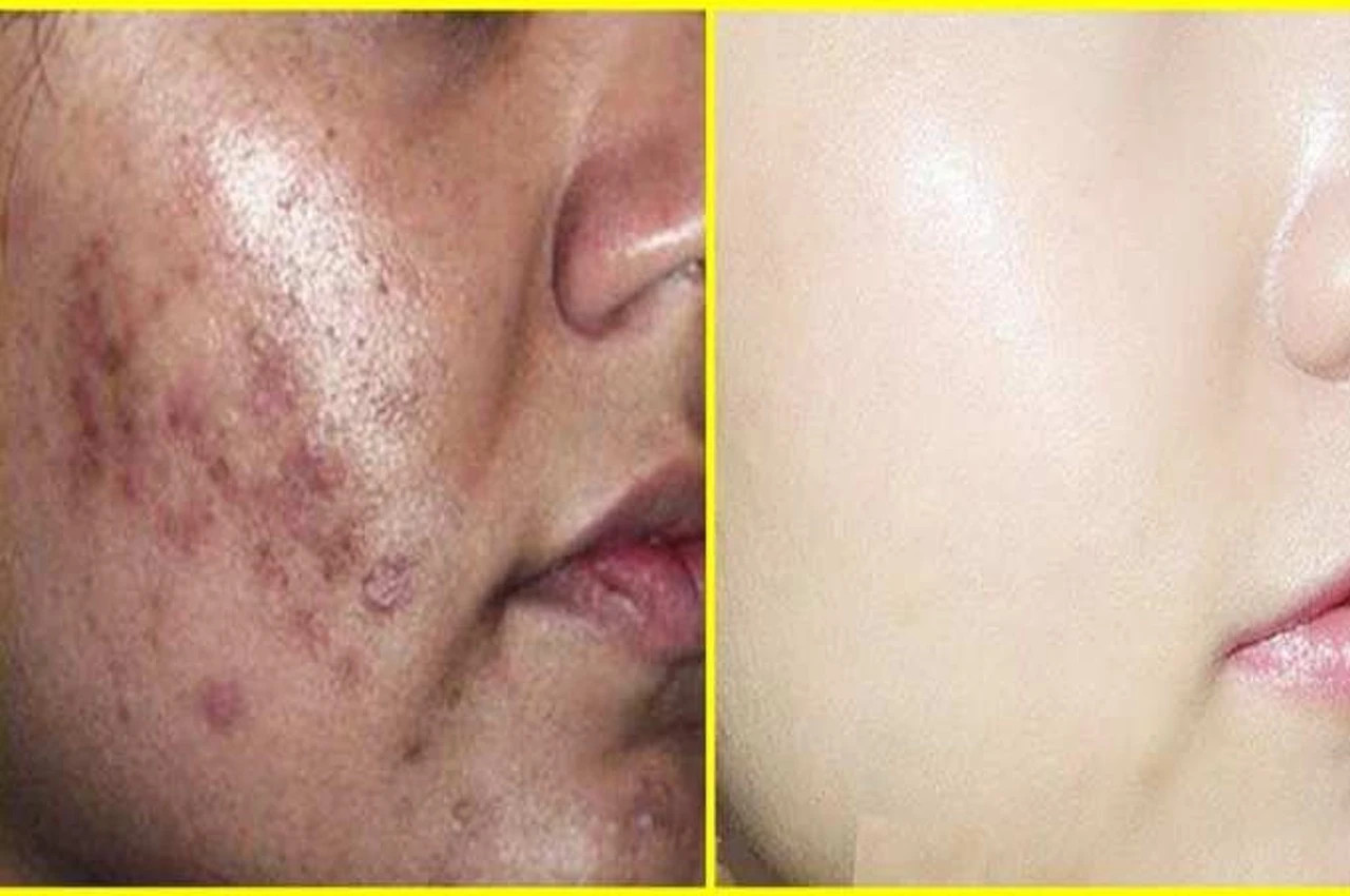 Skin care TIPS Treating Oily Skin