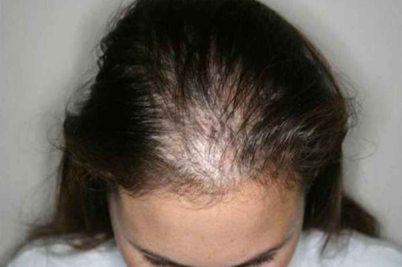 Hair Fall Stop Hair Fall Control jhadte balon ko kese roke