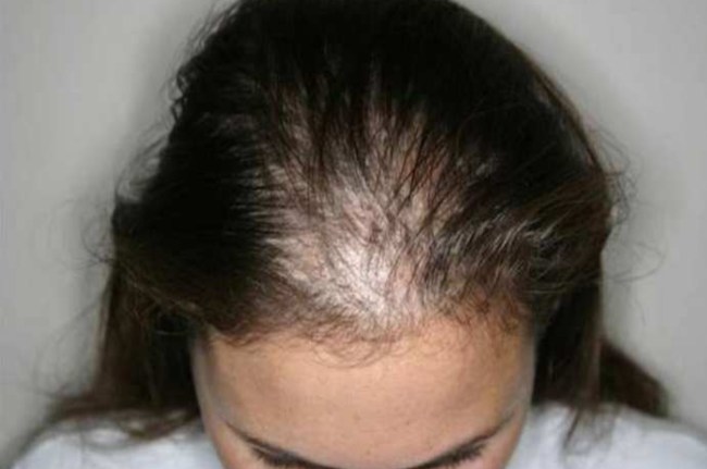 Hair Fall Stop Hair Fall Control jhadte balon ko kese roke