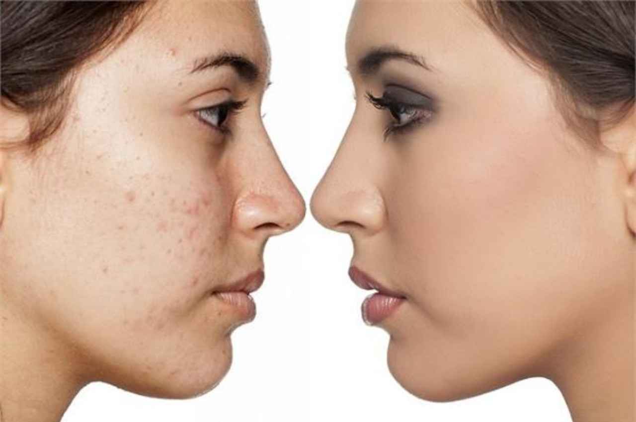 Skin Care TIPS How to remove wrinkles pimples and spots on the face