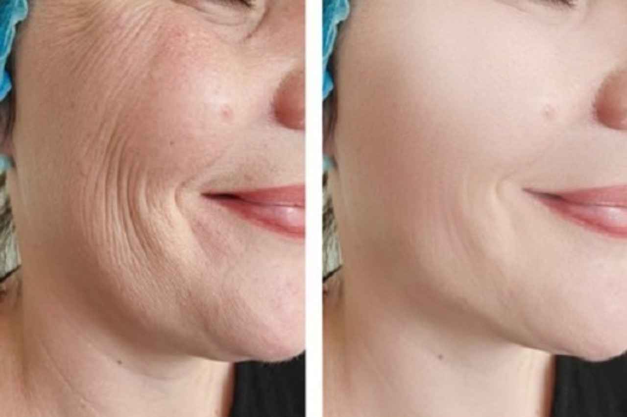 Wrinkles Treatment:  स्किन केयर रूटीन में शामिल करें ये चीजें, रातों-रात गायब हो जाएंगी झुर्रियां