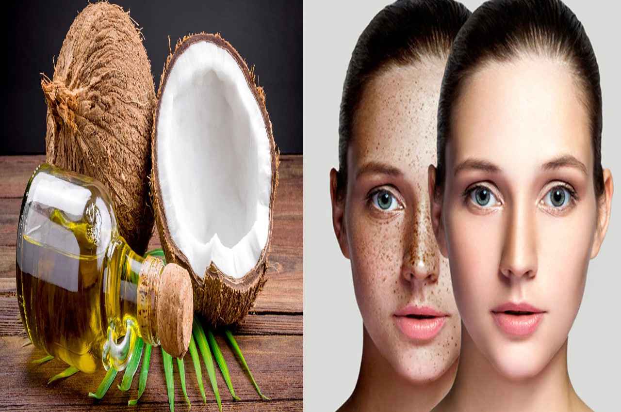 Skin Care TIPS: कील-मुंहासों का सटीक इलाज है नारियल तेल का ये नुस्खा, चेहरे को बना देगा सॉफ्ट, मिलेंगे ये जबरदस्त फायदे