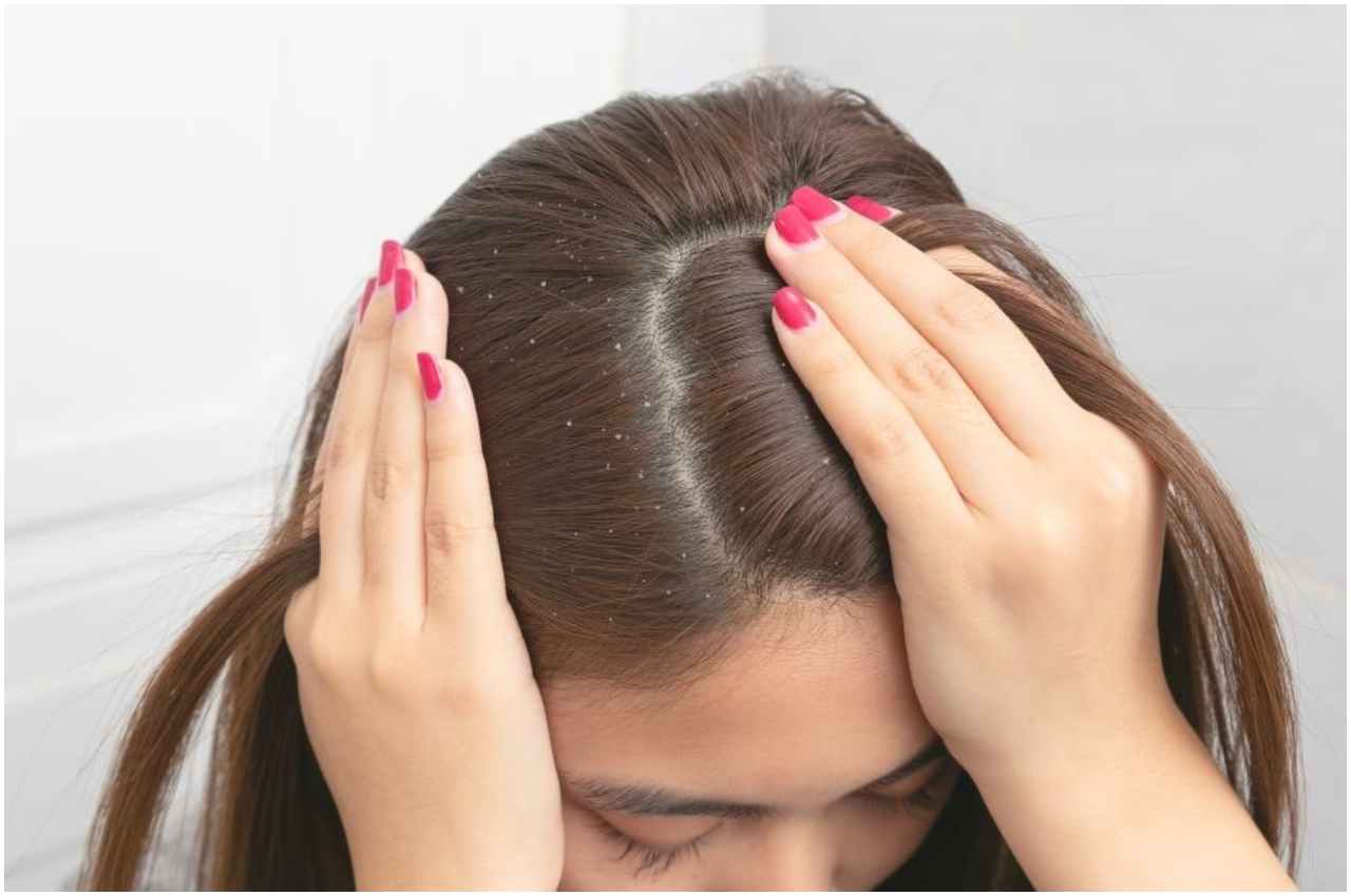 Cause of Dandruff In Hair
